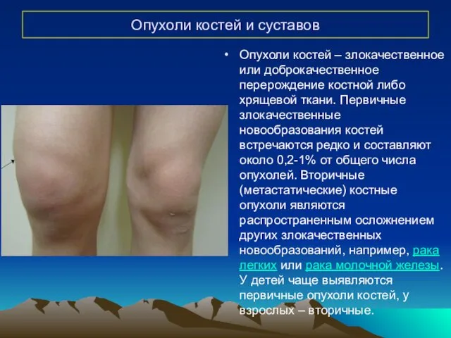 Опухоли костей и суставов Опухоли костей – злокачественное или доброкачественное