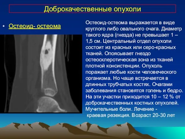 Доброкачественные опухоли Остеоид- остеома Остеоид-остеома выражается в виде круглого либо