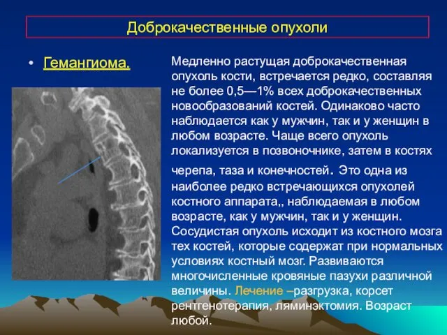 Доброкачественные опухоли Медленно растущая доброкачественная опухоль кости, встречается редко, составляя