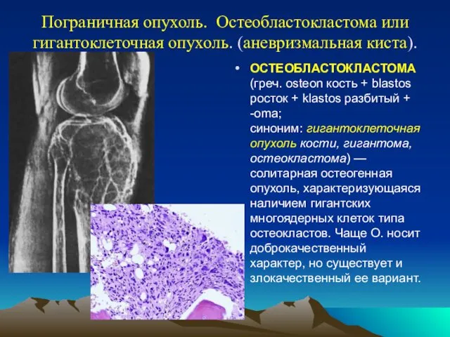 Пограничная опухоль. Остеобластокластома или гигантоклеточная опухоль. (аневризмальная киста). ОСТЕОБЛАСТОКЛАСТОМА (греч.