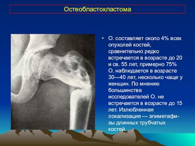 Остеобластокластома О. составляет около 4% всех опухолей костей, сравнительно редко