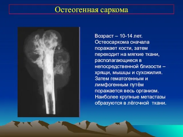 Остеогенная саркома Возраст – 10-14 лет. Остеосаркома сначала поражает кости,