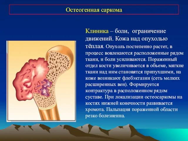 Остеогенная саркома Клиника – боли, ограничение движений. Кожа над опухолью