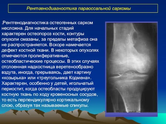 Рентгенодиагностика параоссальной саркомы .Рентгенодиагностика остеогенных сарком несложна. Для начальных стадий