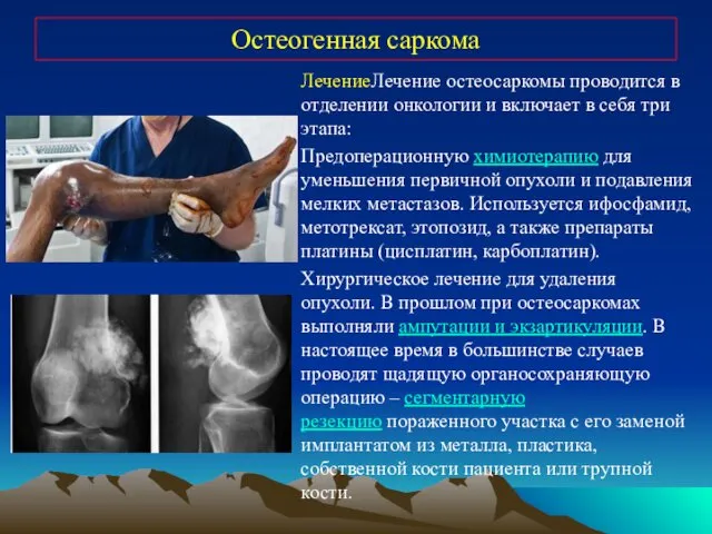 Остеогенная саркома ЛечениеЛечение остеосаркомы проводится в отделении онкологии и включает