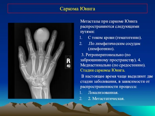 Саркома Юинга Метастазы при саркоме Юинга распространяются следующими путями: С