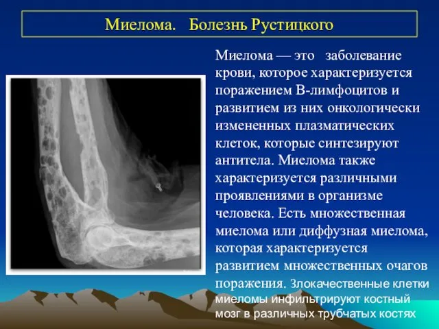 Миелома. Болезнь Рустицкого Миелома — это заболевание крови, которое характеризуется