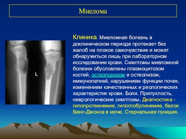 Миелома Клиника. Миеломная болезнь в доклиническом периоде протекает без жалоб