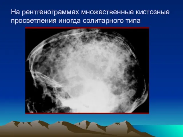 На рентгенограммах множественные кистозные просветления иногда солитарного типа