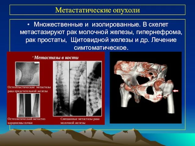 Метастатические опухоли Множественные и изолированные. В скелет метастазируют рак молочной