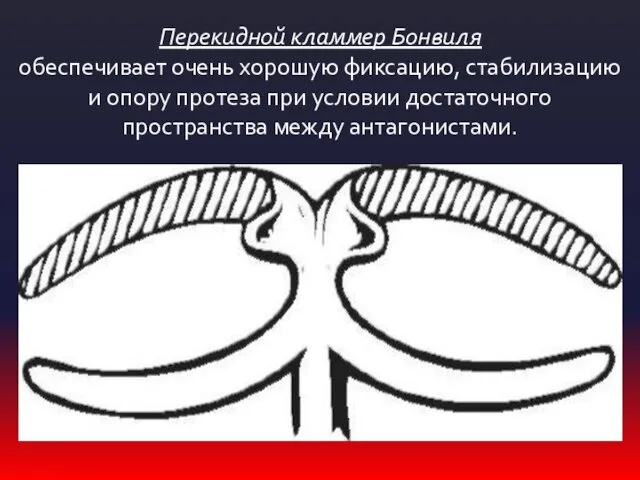 Перекидной кламмер Бонвиля обеспечивает очень хорошую фиксацию, стабилизацию и опору