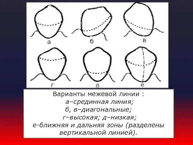 Варианты межевой линии : а–срединная линия; б, в–диагональные; г–высокая; д–низкая;