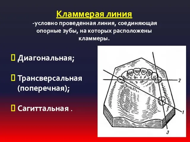 Кламмерая линия -условно проведенная линия, соединяющая опорные зубы, на которых