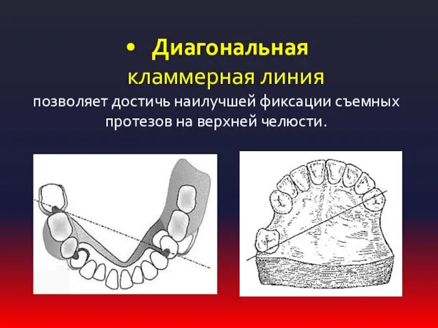 Диагональная кламмерная линия позволяет достичь наилучшей фиксации съемных протезов на верхней челюсти.