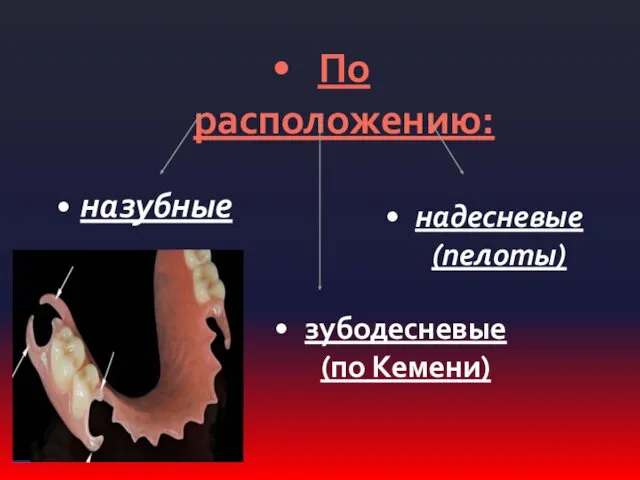 По расположению: назубные надесневые (пелоты) зубодесневые (по Кемени)