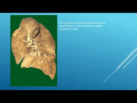 The cut section of the hyperinflated lung of a patient