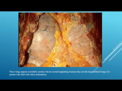 These lungs appear essentially normal, but are normal-appearing because they
