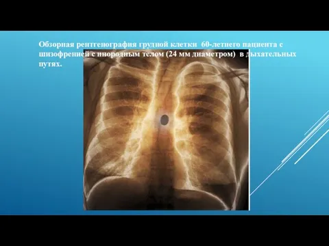 Обзорная рентгенография грудной клетки 60-летнего пациента с шизофренией с инородным