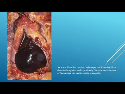 An aortic dissection may lead to hemopericardium when blood dissects