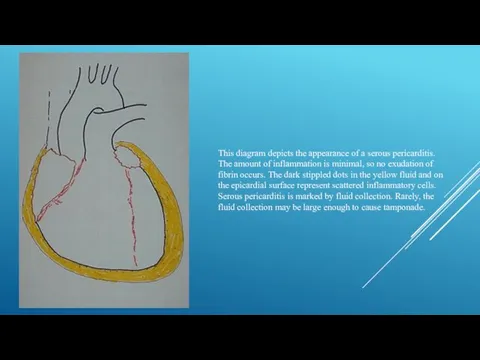 This diagram depicts the appearance of a serous pericarditis. The