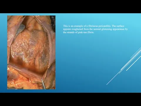 This is an example of a fibrinous pericarditis. The surface