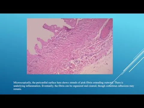 Microscopically, the pericardial surface here shows strands of pink fibrin