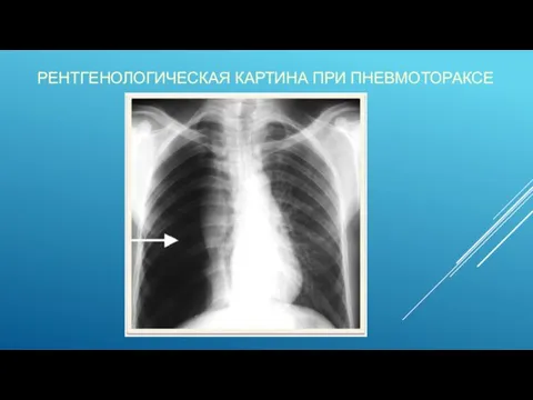 РЕНТГЕНОЛОГИЧЕСКАЯ КАРТИНА ПРИ ПНЕВМОТОРАКСЕ