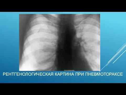 РЕНТГЕНОЛОГИЧЕСКАЯ КАРТИНА ПРИ ПНЕВМОТОРАКСЕ