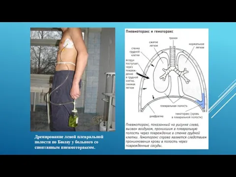 Дренирование левой плевральной полости по Бюлау у больного со спонтанным пневмотораксом.