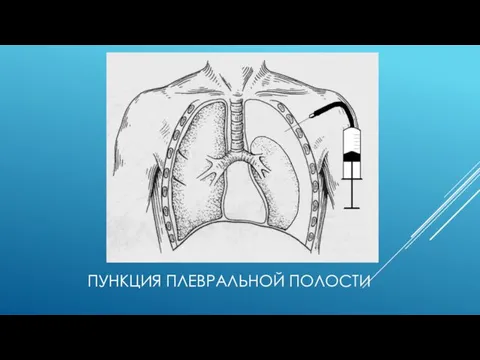 ПУНКЦИЯ ПЛЕВРАЛЬНОЙ ПОЛОСТИ