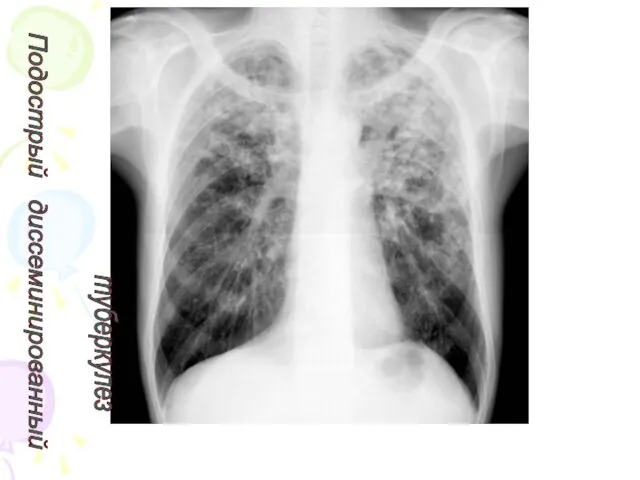 Подострый диссеминированный туберкулез