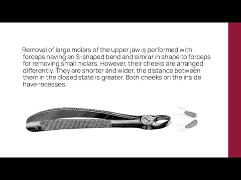 Removal of large molars of the upper jaw is performed