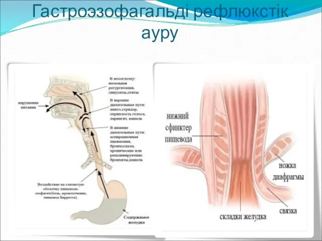 Гастроэзофагальді рефлюкстік ауру