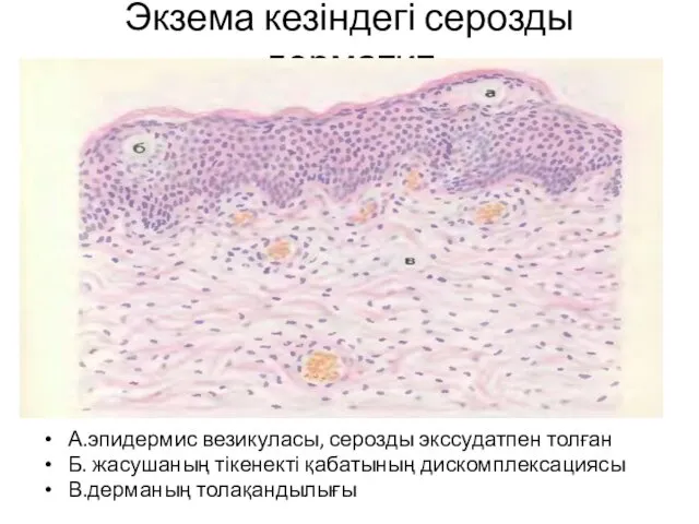 Экзема кезіндегі серозды дерматит А.эпидермис везикуласы, серозды экссудатпен толған Б. жасушаның тікенекті қабатының дискомплексациясы В.дерманың толақандылығы