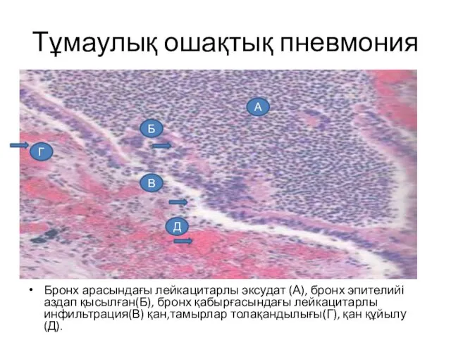 Тұмаулық ошақтық пневмония Бронх арасындағы лейкацитарлы эксудат (А), бронх эпителийі