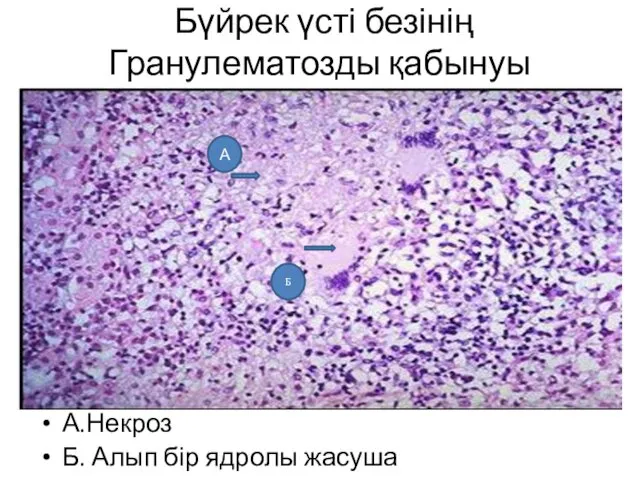 Бүйрек үсті безінің Гранулематозды қабынуы А.Некроз Б. Алып бір ядролы жасуша А Б