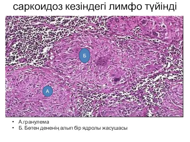 саркоидоз кезіндегі лимфо түйінді А.гранулема Б. Бөтен дененің алып бір ядролы жасушасы А Б