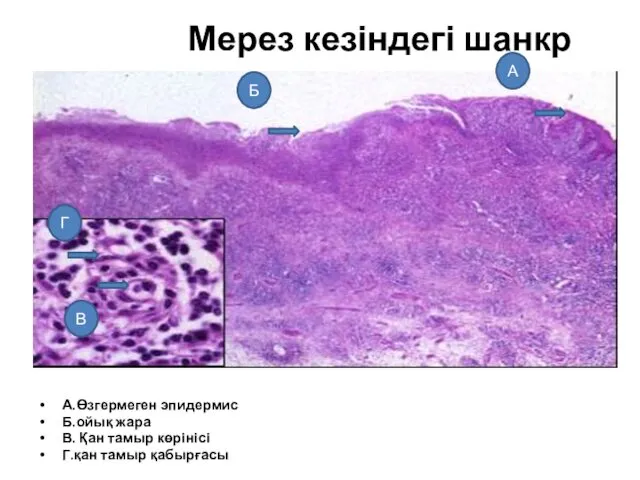 Мерез кезіндегі шанкр А.Өзгермеген эпидермис Б.ойық жара В. Қан тамыр