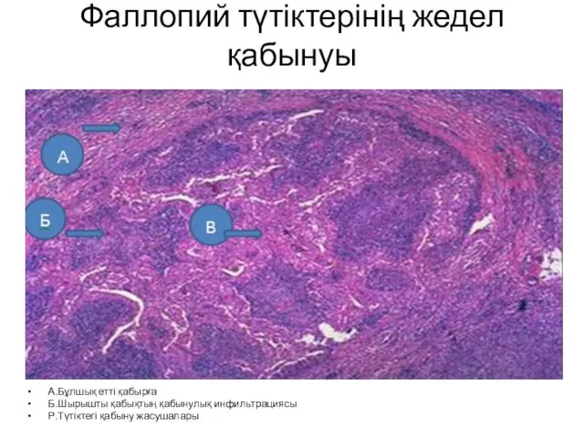 Фаллопий түтіктерінің жедел қабынуы А.Бұлшық етті қабырға Б.Шырышты қабықтың қабынулық инфильтрациясы Р.Түтіктегі қабыну жасушалары