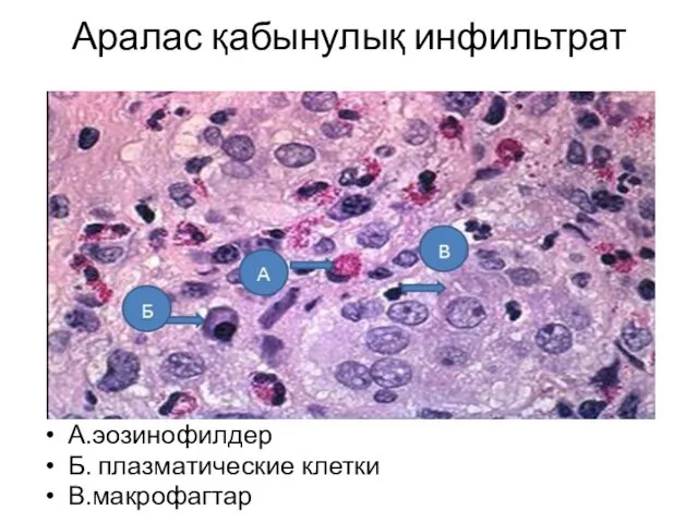 Аралас қабынулық инфильтрат А.эозинофилдер Б. плазматические клетки В.макрофагтар