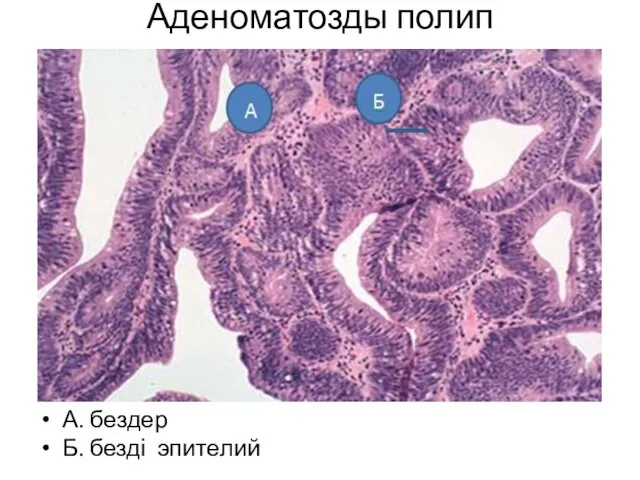 Аденоматозды полип А. бездер Б. безді эпителий Аденоматозный полип А.Железы Б. железистый эпителий