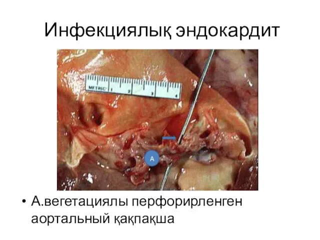 Инфекциялық эндокардит А.вегетациялы перфорирленген аортальный қақпақша