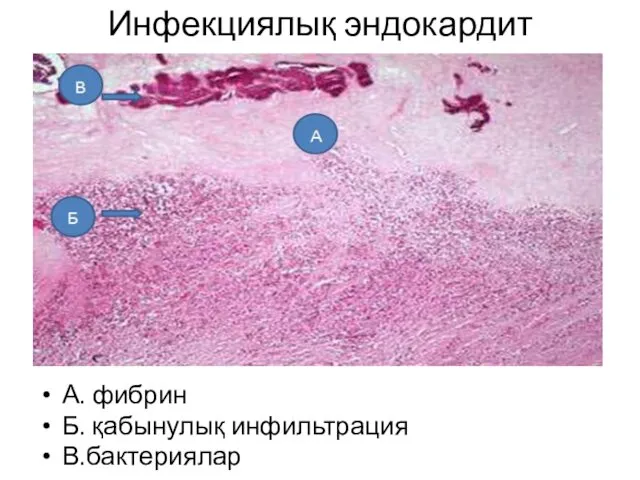 Инфекциялық эндокардит А. фибрин Б. қабынулық инфильтрация В.бактериялар