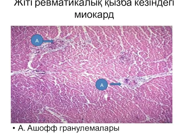 Жіті ревматикалық қызба кезіндегі миокард А. Ашофф гранулемалары