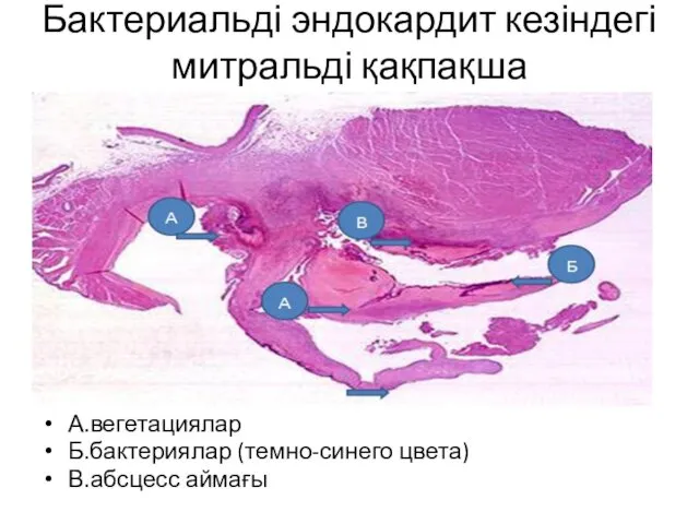Бактериальді эндокардит кезіндегі митральді қақпақша А.вегетациялар Б.бактериялар (темно-синего цвета) В.абсцесс аймағы