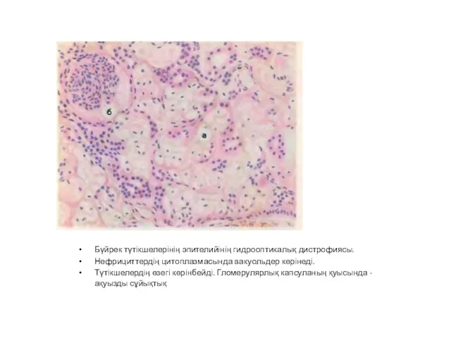 Бүйрек түтікшелерінің эпителийінің гидрооптикалық дистрофиясы. Нефрициттердің цитоплазмасында вакуольдер көрінеді. Түтікшелердің