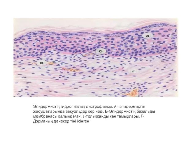 Эпидермистің гидропиялық дистрофиясы. A - эпидермистің жасушаларында вакуольдер көрінеді. Б-Эпидермистің
