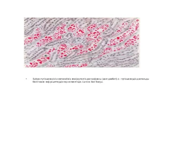 Бүйрек түтікшелерінің эпителийінің көмірсутектік дистрофиясы (қант диабеті) A – түтікшелердің