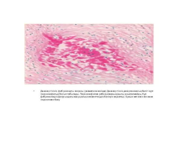 Дәнекер тінінің фибриноидты некрозы (ревматизм кезінде) Дәнекер тіннің дезорганикалық бөлігі