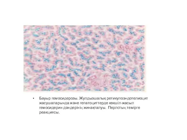 Бауыр гемосидерозы. Жулдызшалық ретикулоэндотелиоцит жасушаларында және гепатоциттерде көкшіл-жасыл гемосидерин дәндерінің жинақталуы. Перлстың темірге реакциясы.